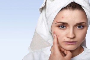 chochlate and oily food increses pimple problem