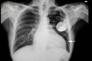 pulmonary edema causes