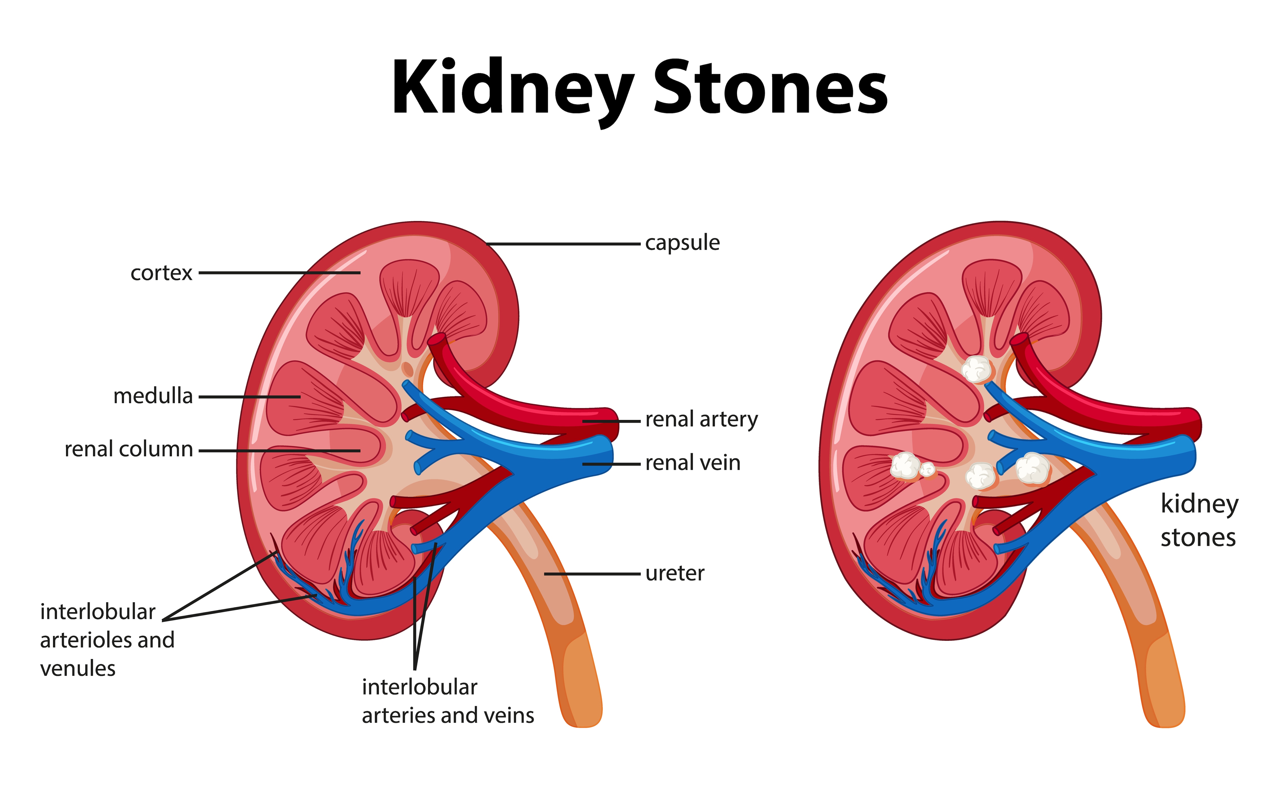kidney stone diet