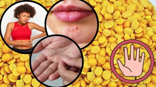 Toor Dal Works Like Poison For Uric Acid Swelling Redness On Skin Pimples Indigestion Who Should Not Consume Dal