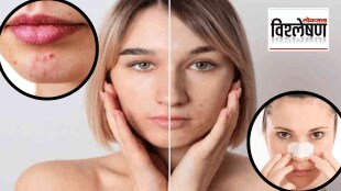 Why Do you Get Pimple On The Same Spot Blackheads T Zone Face Cleansing Hacks Explained