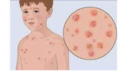 Measles Outbreak in Pune