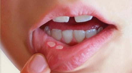mouth ulcer home remedies