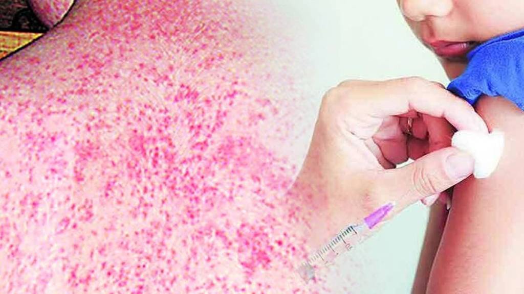 two patients of measles have been found in nagpur