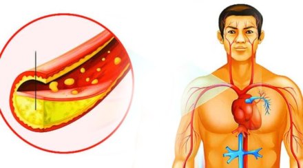cholesterol sign