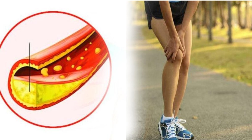 cholesterol symptoms in legs