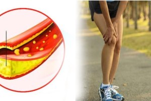 cholesterol symptoms in legs