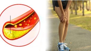 cholesterol symptoms in legs