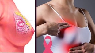 breast cancer