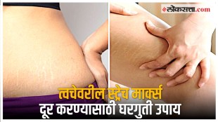 tips to remove stretch marks