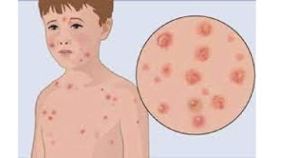 measles in pune