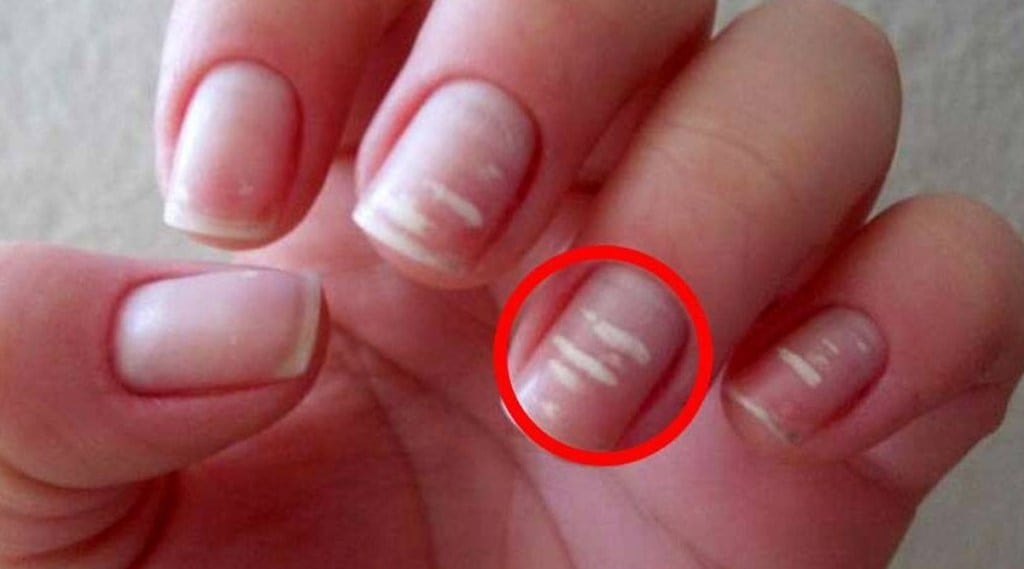 white spot on nails