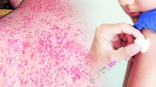Mumbai Measles Treatment