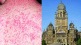 Mumbai Municipal Corporation will spread awareness about measles and vaccination through wrappers