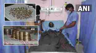 karnataka patient swallows coin
