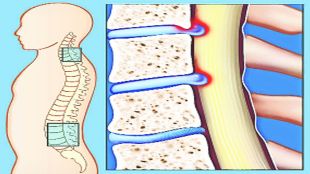 lekh back pain