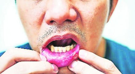 जगातील ५० टक्के नागरिक तोंडाच्या आजारांनी ग्रस्त; तंबाखू सेवन, दंतरोग आणि स्वच्छतेच्या अभावामुळे मौखिक आरोग्यास धोका