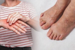 swelling in hands and toes