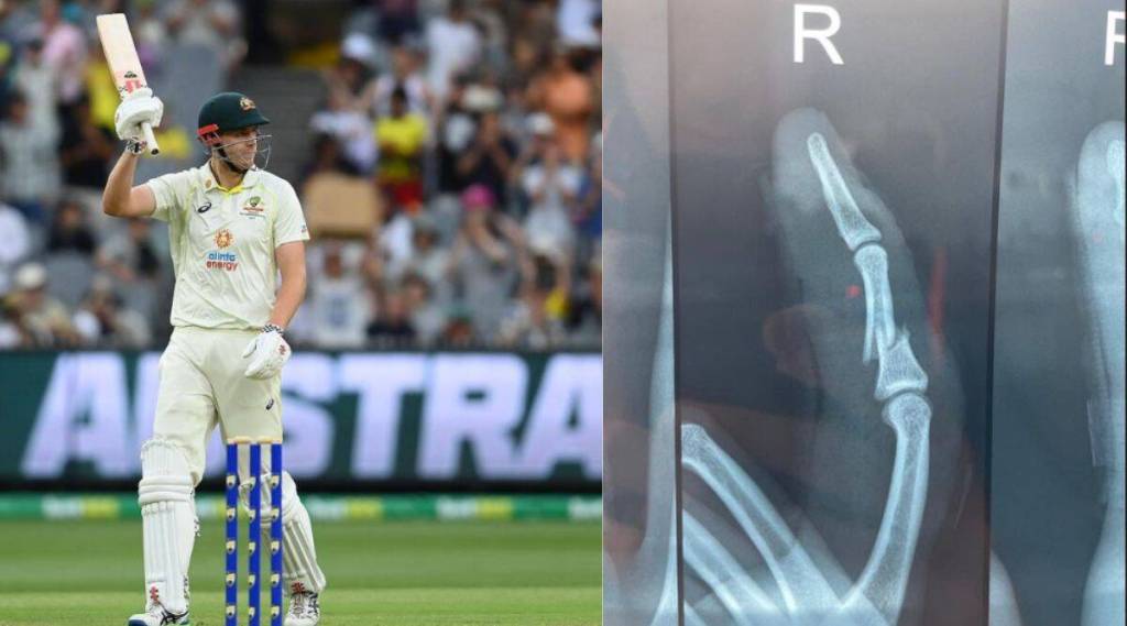 Cameron Greene Injured: ‘बोट मोडले पण हिंमत नाही हारली’, १७७ चेंडूंचा सामना करणाऱ्या ग्रीनने शेअर केला फ्रॅक्चर बोटाचा फोटो