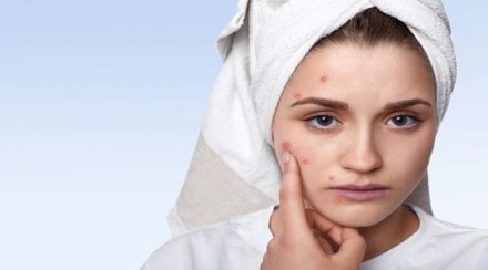 Which type of food can cause pimple acne problem try to avoid in daily diet