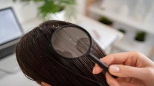 Why dandruff increases in winter know the reason behind it