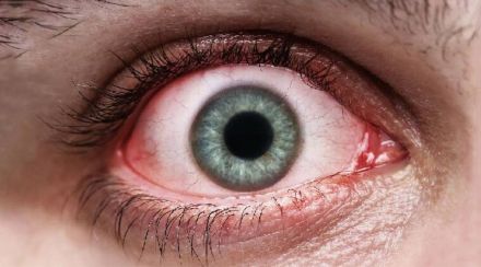 red eyes symptoms