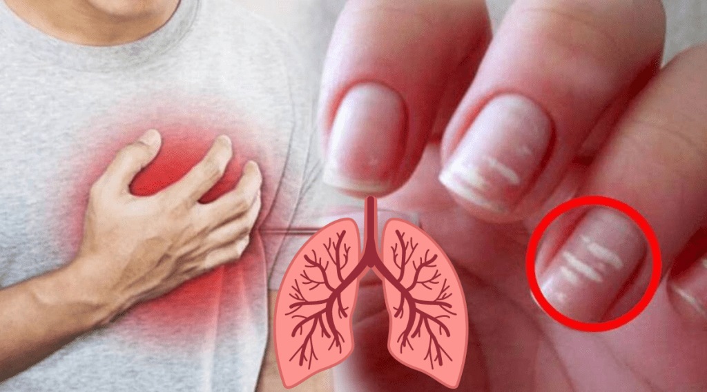 White Spots on Nails Are Not Because of Calcium Deficiency Heart and Lungs Failure Signs By Body Know from Expert
