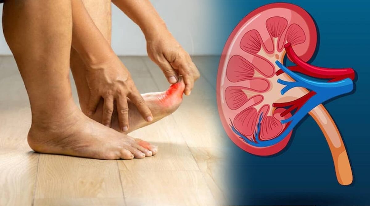 high uric acid causes kidney failure