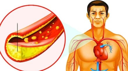 high cholesterol causes