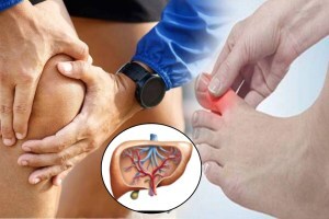 liver failure sign