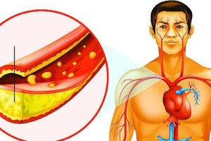 high cholesterol control tips