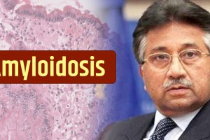 pervej musharraf death amyloidosis disease