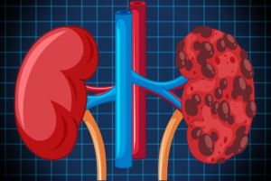 tips for dialysis patients