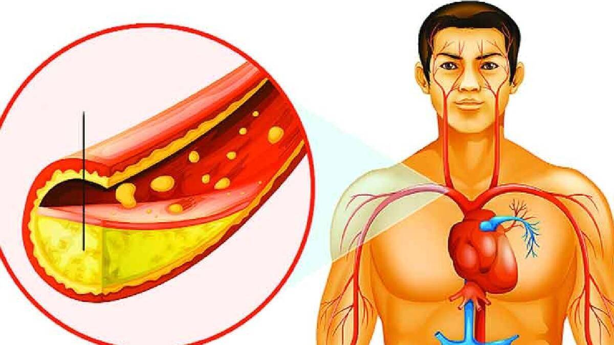 lemon garlic for bad cholesterol