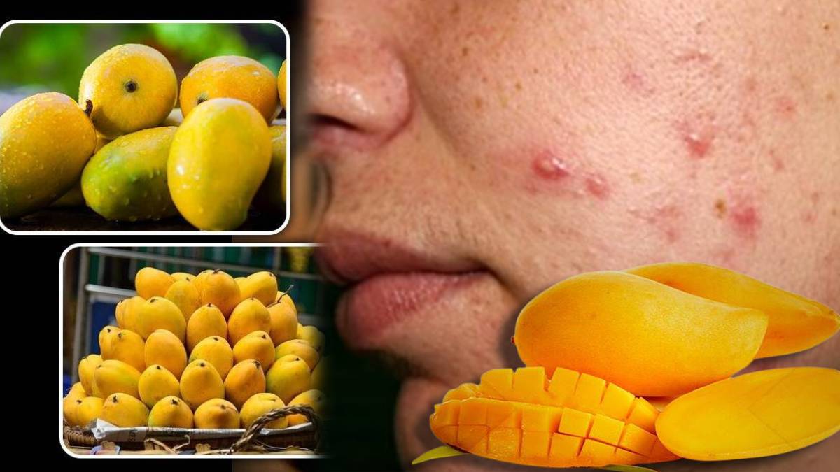 Can Mango Really Cause Acne Pimples Myths Busted by Dietician How