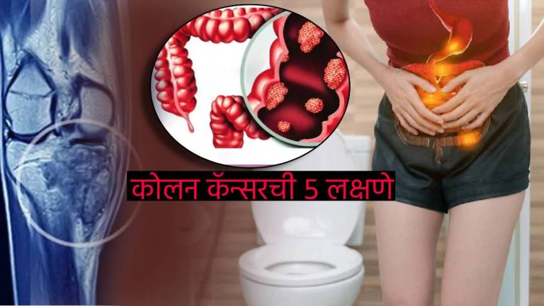 Colon Cancer Early Signs Extreme Tiredness Constipation Irregular Bowl Movements How To Identify Cancer at early stage Health Expert
