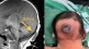 Successful surgery of a tumor on the head of a 5 day old baby in Kolhapur