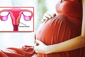 women with mental illness more than twice at risk of developing cervical cancer said Study