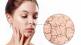 dullness to dry skin dehydration symptoms on skin in marathi