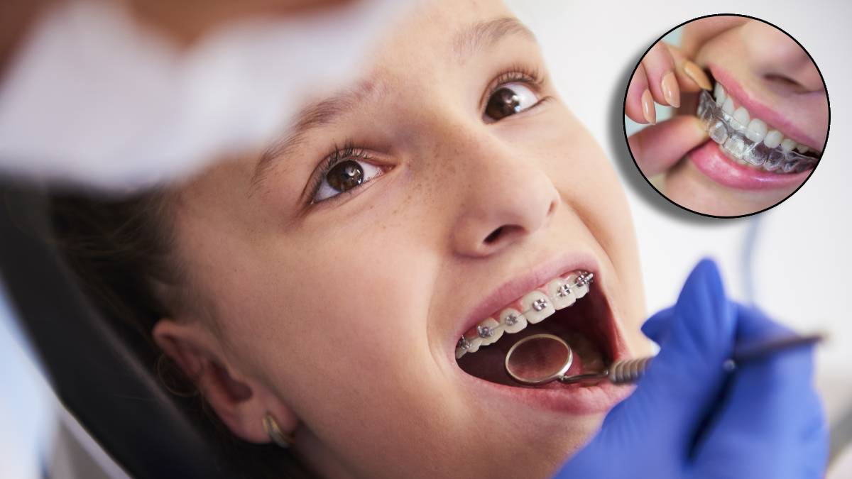 invisalings aligners wearing benefits