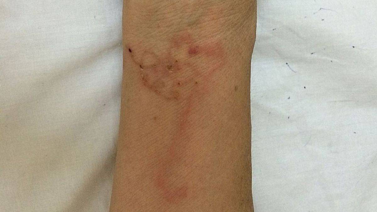 parasitic worm infections