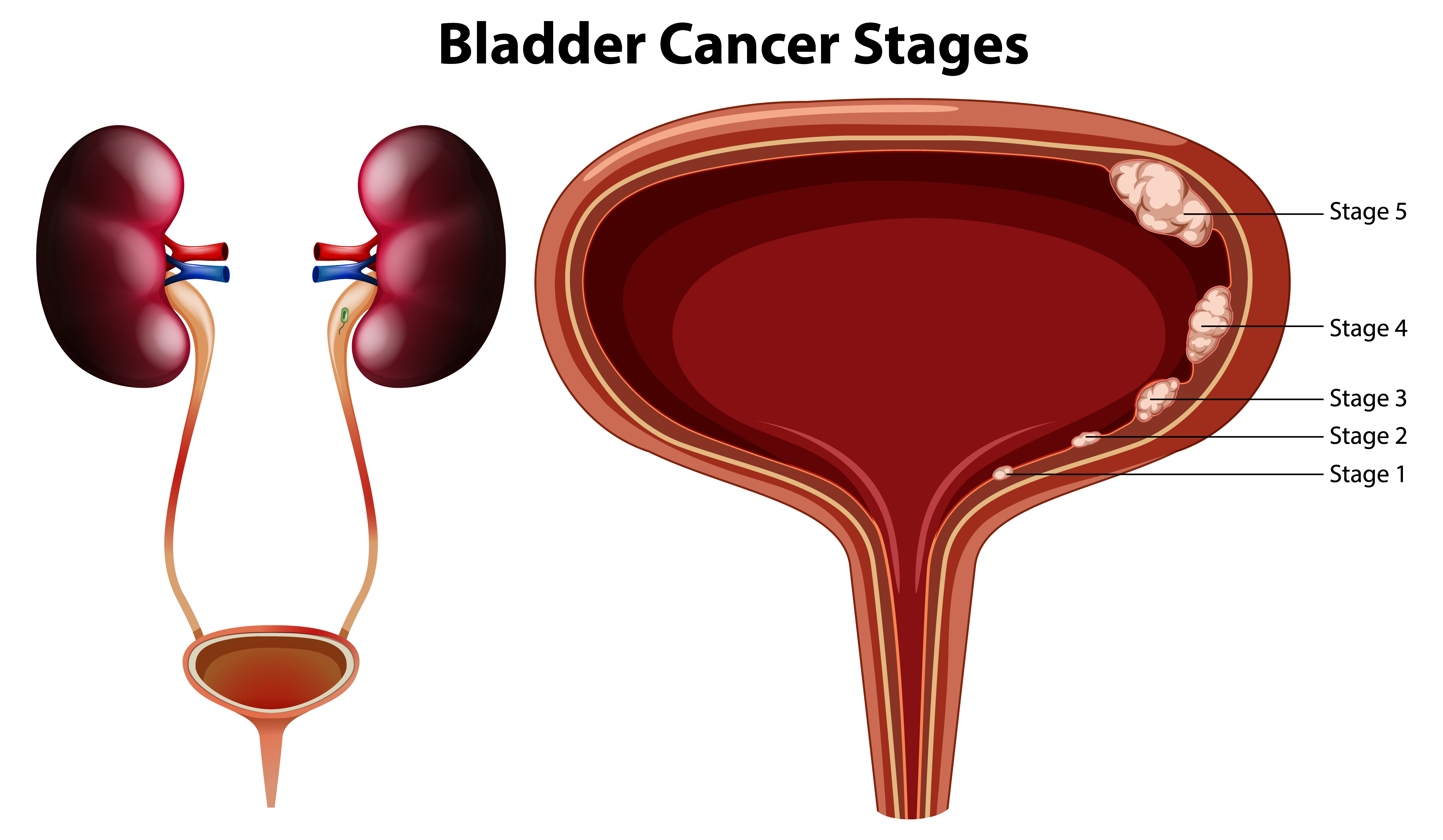 bladder-cancer-symptoms