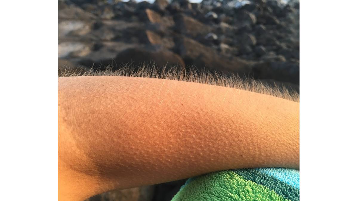 Goosebumps