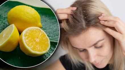 dandruff and lemon juice