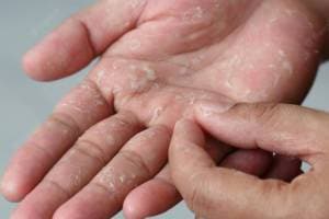 skin peeling causes home remedies