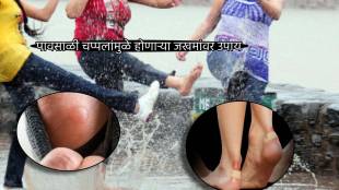 Monsoon Footwear Shoe Bite Remedies To Save Money And Pain From Wounds Burning Choose Sandals Jugadu Tips