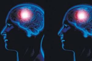 Brain Tumour Signs and symptoms
