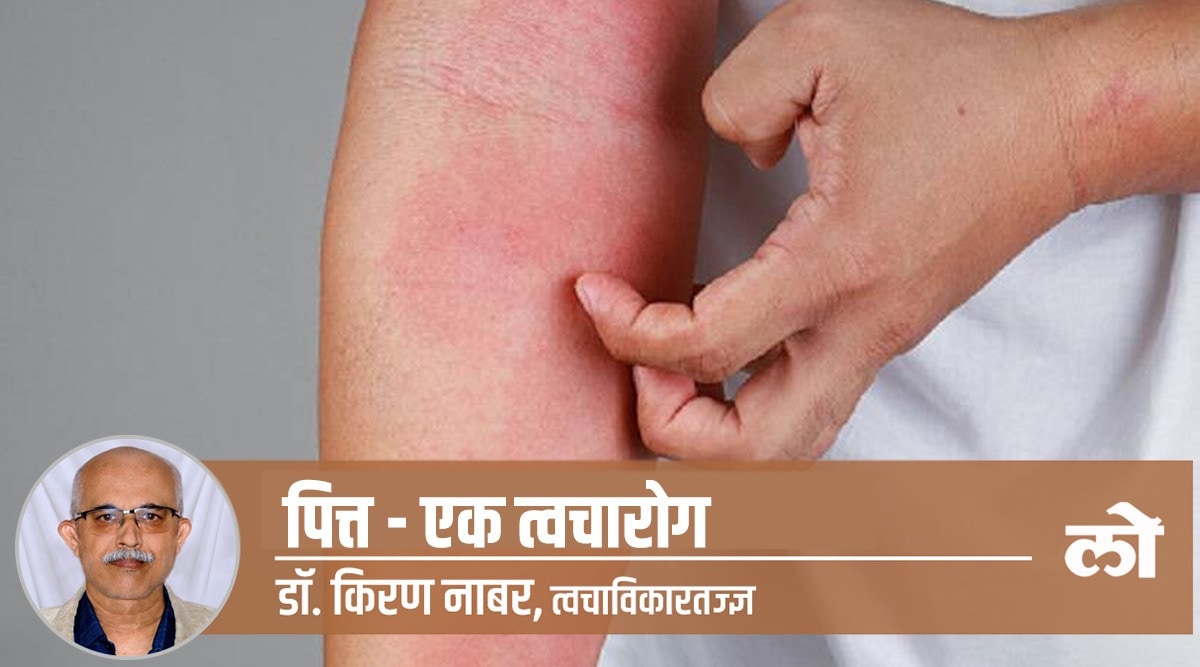 hives pitta skin problem