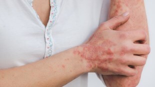 psoriasis health
