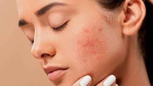 Skin Care Mistakes How To Remove Pimples